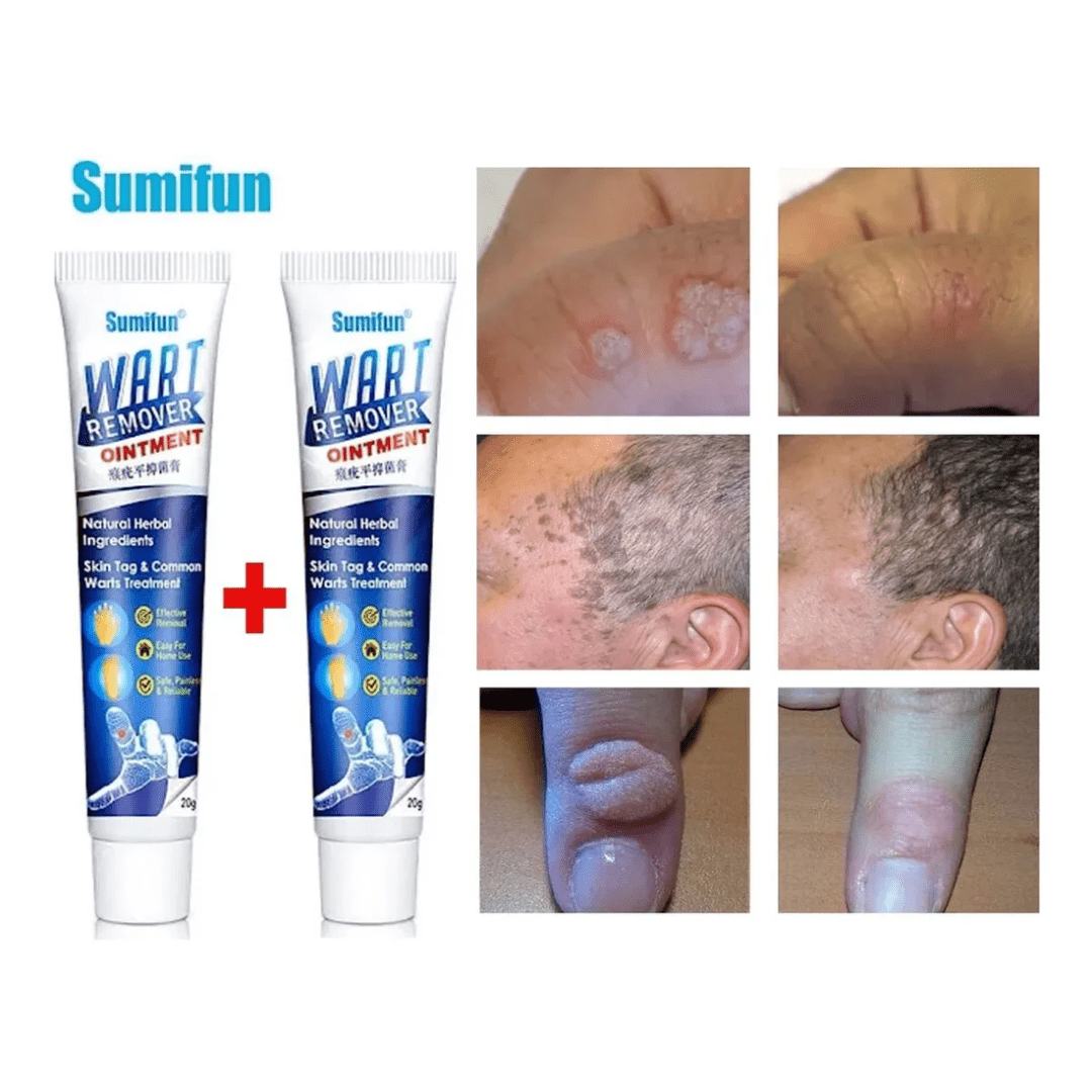 WART REMOVER - REMOVEDOR DE VERRUGA